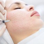 Needle mesotherapy in beauty spa salon or clinic. Cosmetics been injected to woman's face, close up portrait